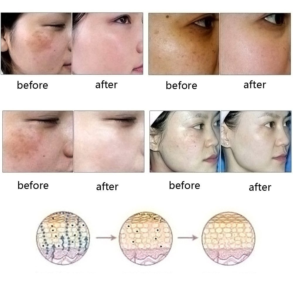 Aceite esencial Dredge Meridian Skin Care para eliminar cicatrices, estrías y acné.